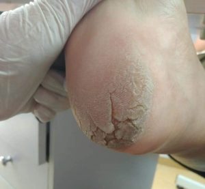 centru medical tratament calcaie crapate craiova